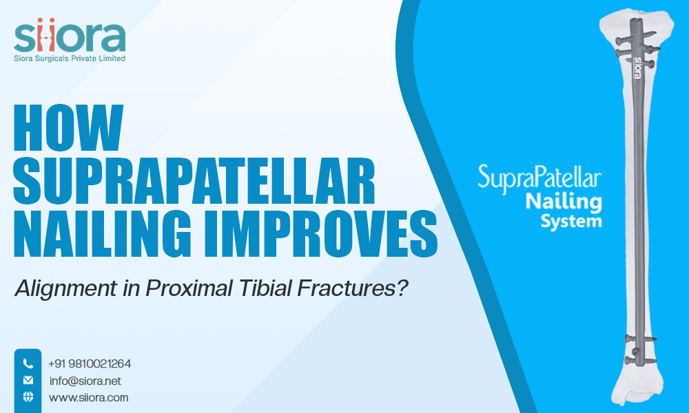 Suprapatellar Nailing